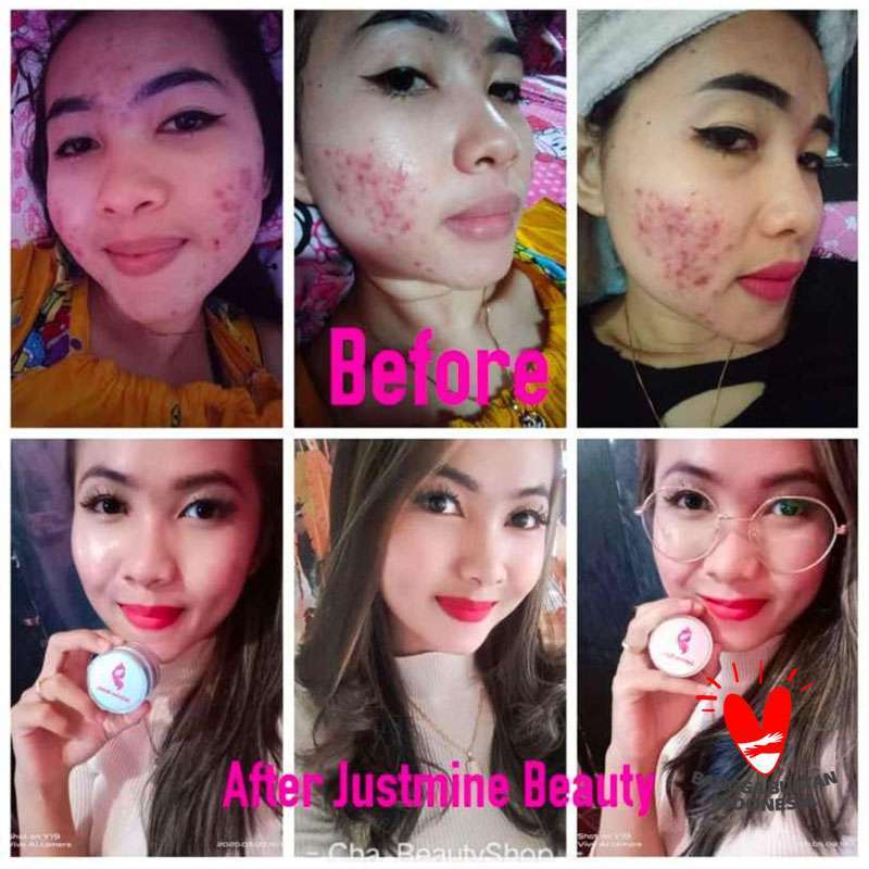 cream justmine acne