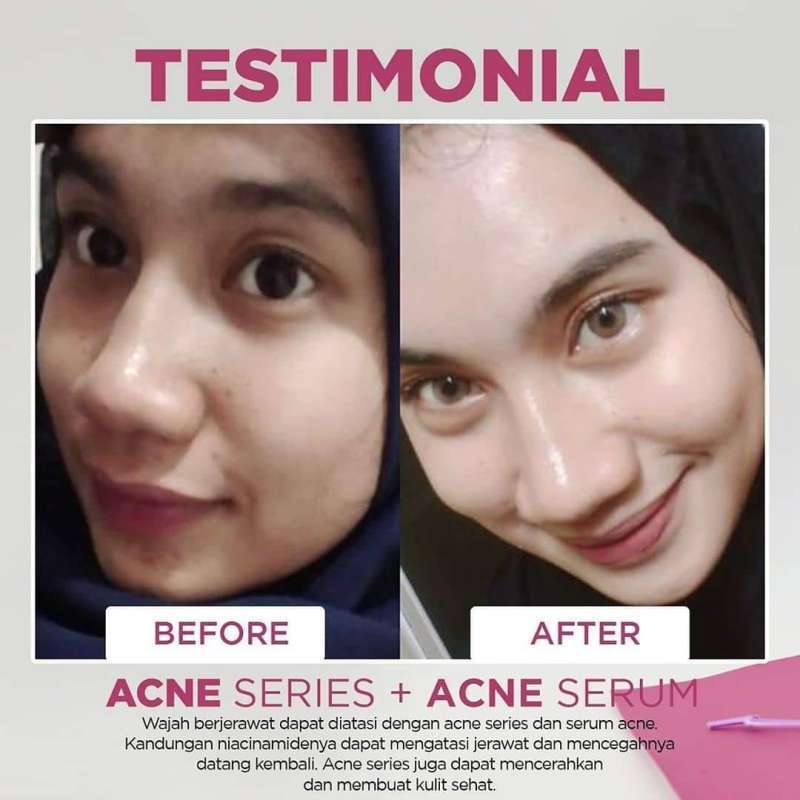Jual Ms Glow Acne Super Cream 1 Paket Lengkap Serum Acne Free Tas Cantik Paket Jerawat Parah Terbaru Juli 2021 Blibli