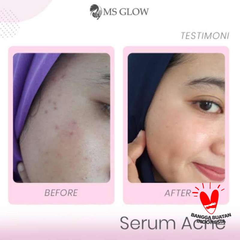 serum acne glow