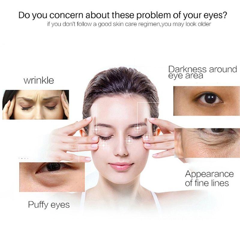 lines under eyes at 16