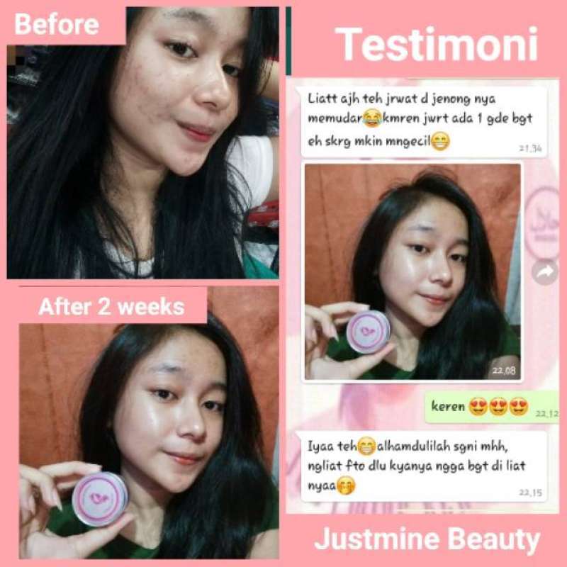 cream justmine acne