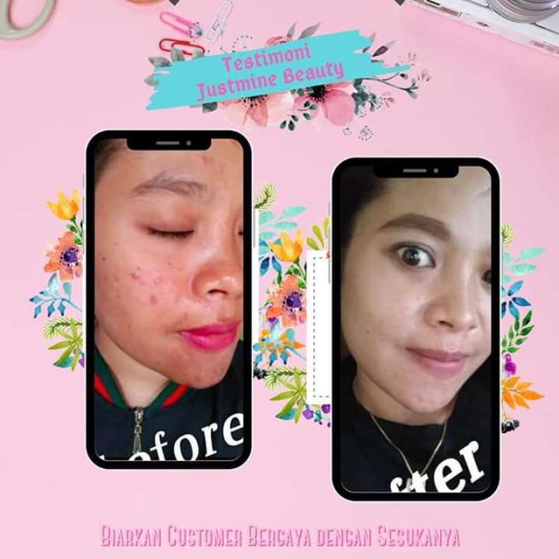 cream justmine acne