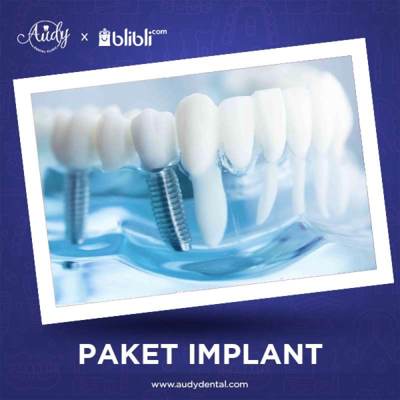 Jual Audy Dental Clinic Pondok Bambu Paket Implan Gigi Voucher Kesehatan Terbaru November 2021 Harga Murah Kualitas Terjamin Blibli
