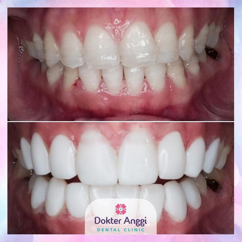 Dokter Anggi Dental Clinic Veneer Composite 8 Gigi Terbaru Agustus 2021 Harga Murah Kualitas Terjamin Blibli