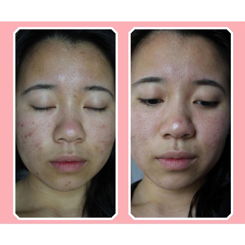 Jual Aura Beauty Cream Obat Jerawat Online Oktober 2020 Blibli Com Jerawat di punggung sering kali mengganggu dan sulit untuk diatasi, tapi ada kok beberapa sabun batang yang bisa kalian jadikan pilihan untuk membantu mengatasinya. blibli