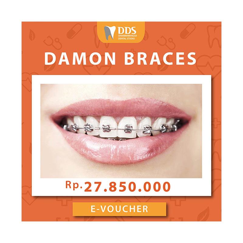 Harga braces deals