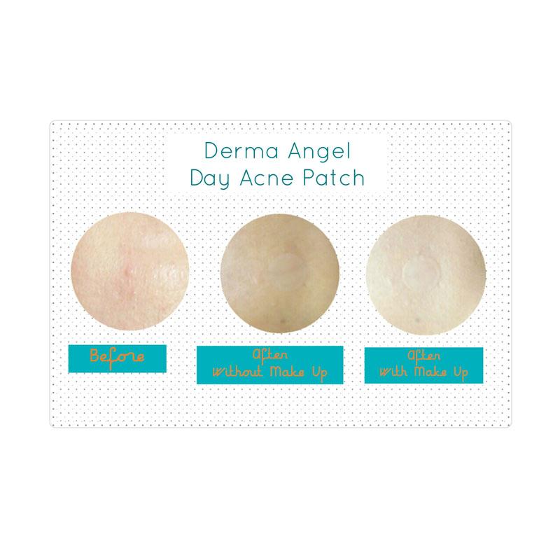 Jual Derma Angel Acne Patch Day Plester Jerawat 3 Pcs Original Korea Online Desember 2020 Blibli
