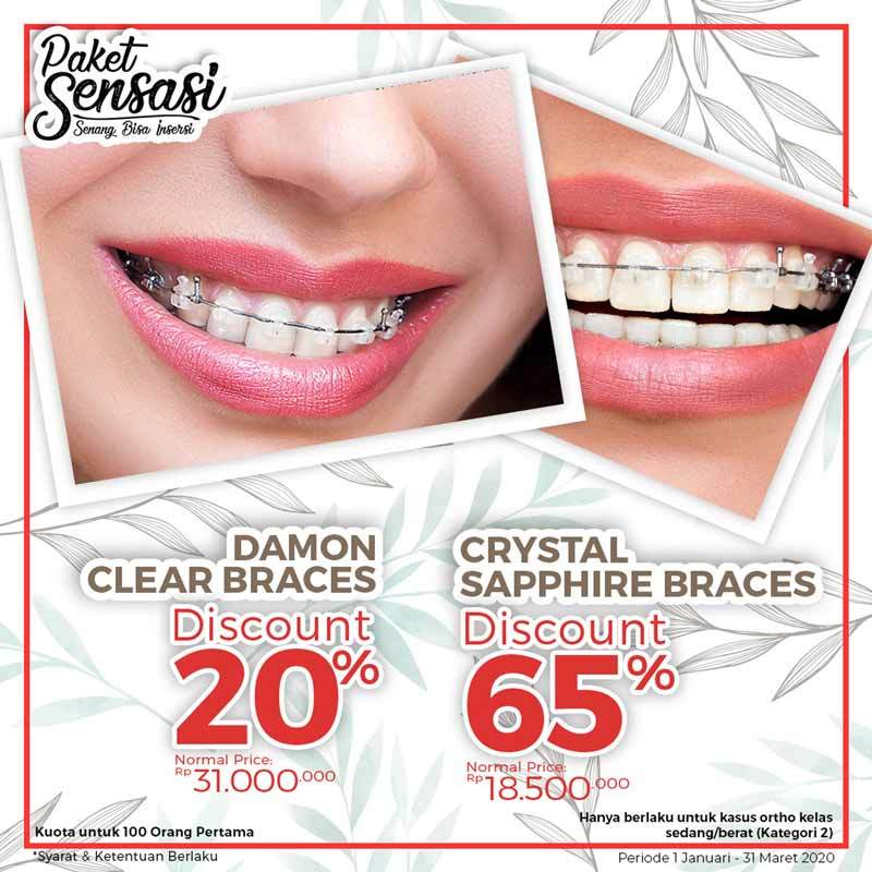 Harga braces 2020 hot sale