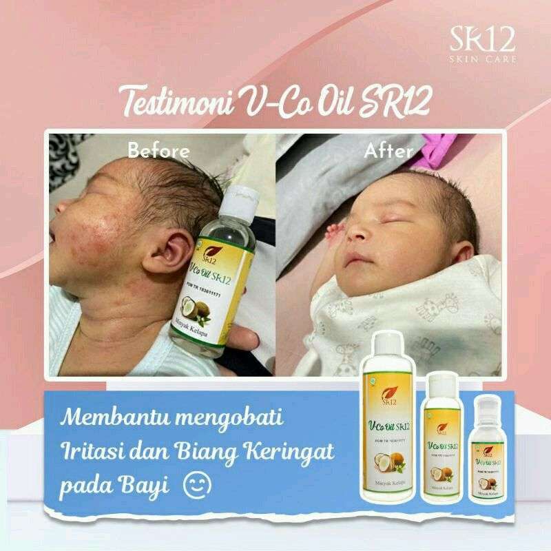Obat biang keringat pada bayi