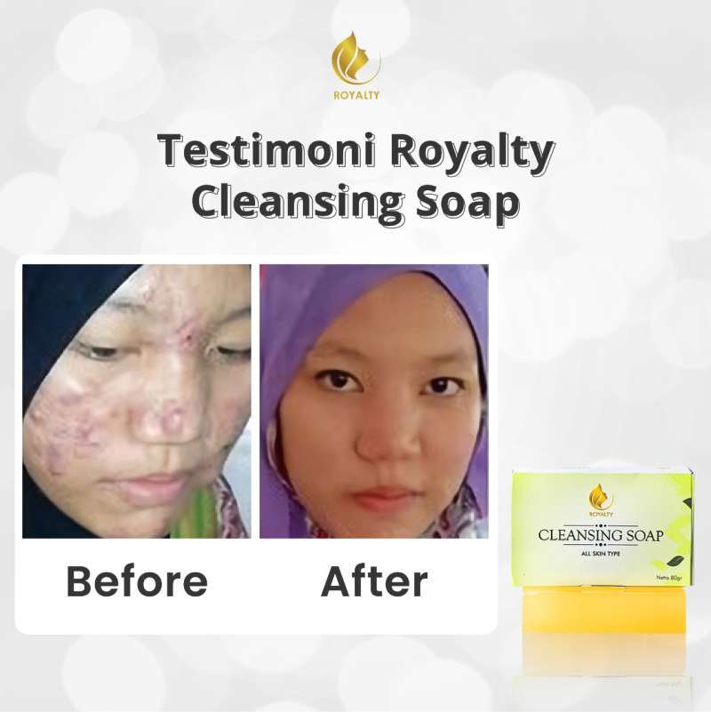 Jual Sabun Pemutih Wajah Menghilangkan Jerawat Bekas Jerawat Bisa Untuk Badan Royalty Cleansing Soap Online Desember 2020 Blibli