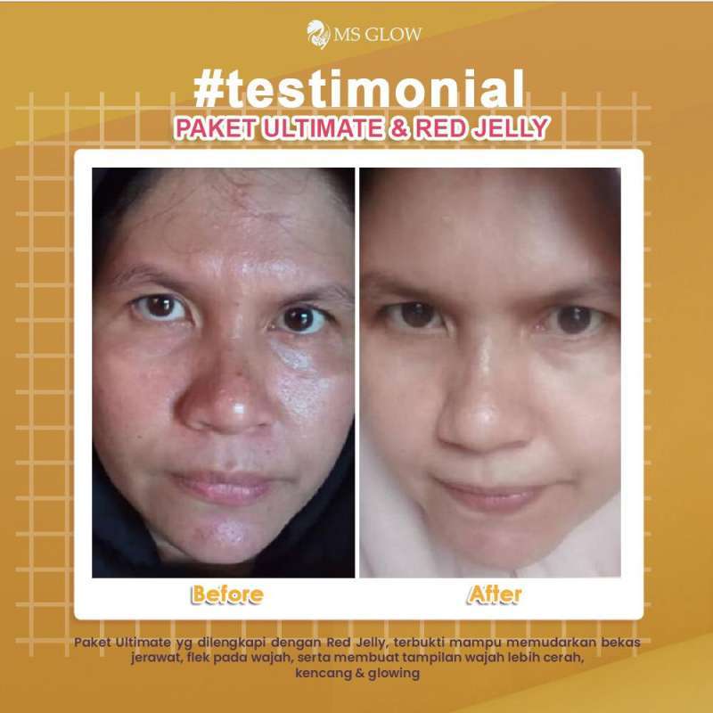Jual Ms GLow Paket Ultimate Series untuk Kulit Flek Hitam ...