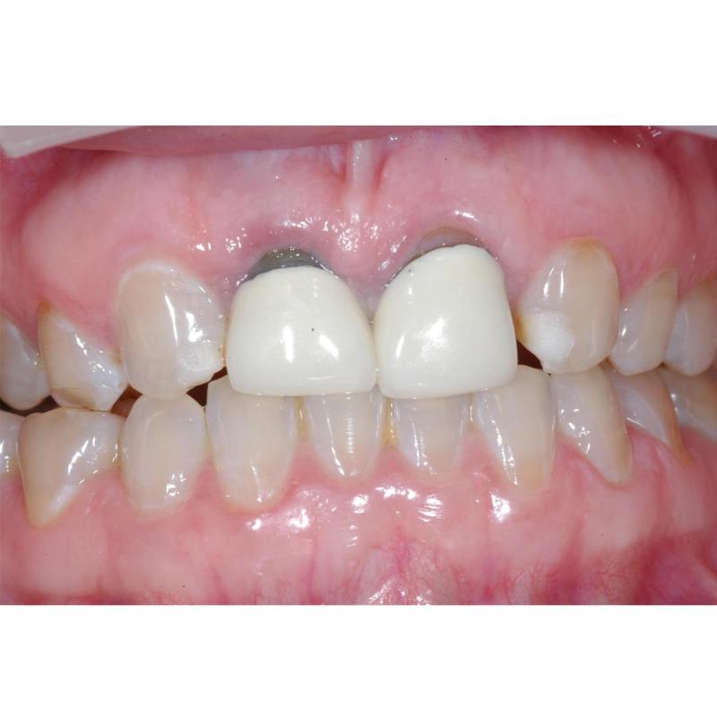 Jual Dokter Anggi Dental Clinic Crown All Porceline E Voucher Di Seller Dokter Anggi Dental Clinic Kota Depok Jawa Barat Blibli