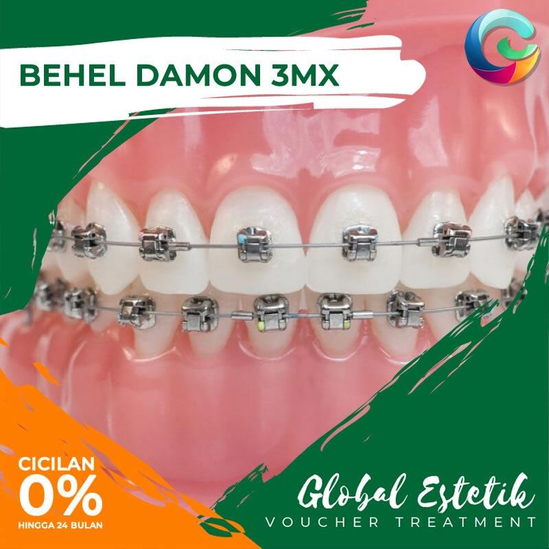 Jual Global Estetik Behel Damon Metal 3mx Ticket Treatment Online Desember 2020 Blibli