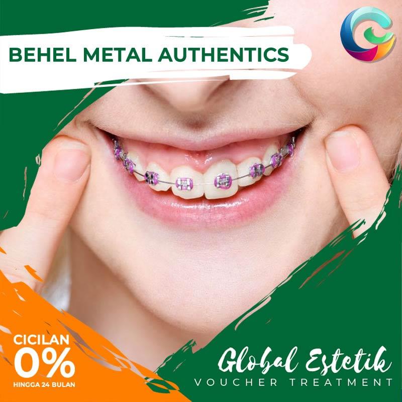 Jual Global Estetik Treatment Behel Metal Authentics Ticket Online Januari 2021 Blibli