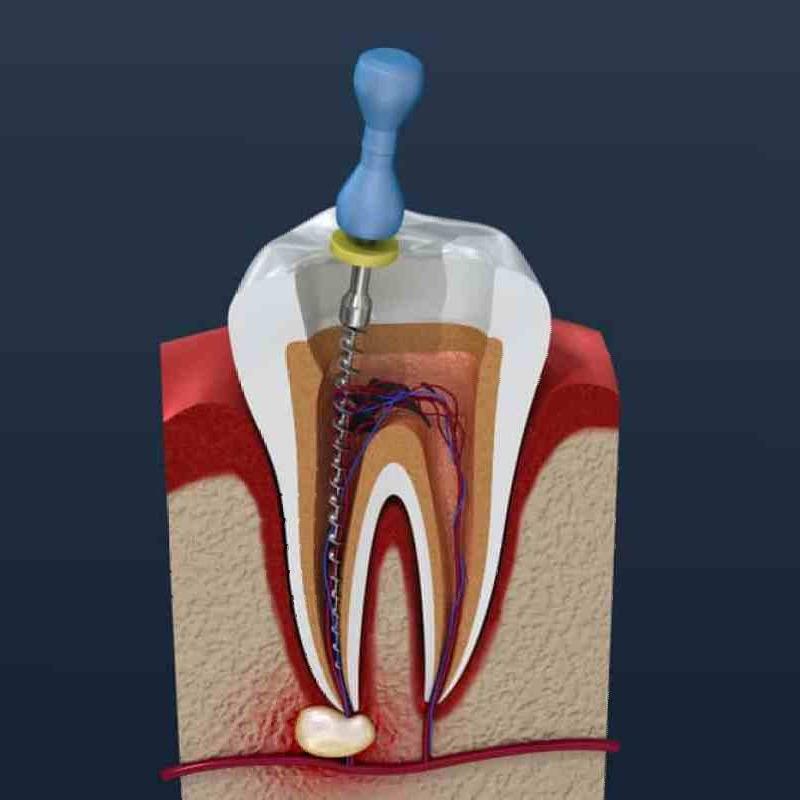 Jual PSA Single Visit di Seller Crown Dental Solution Semolowaru