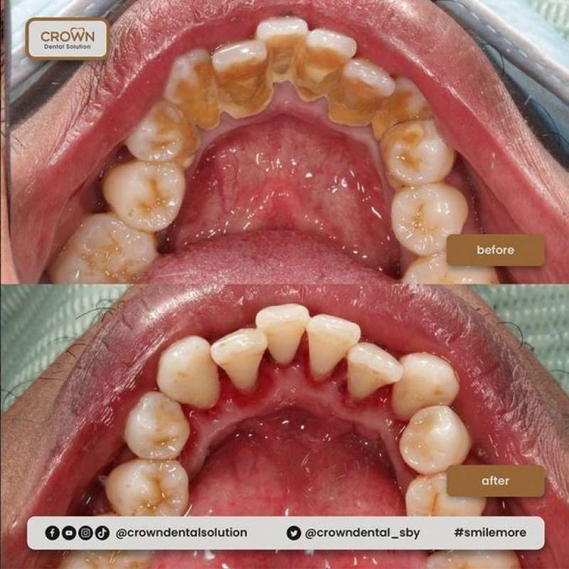 Jual Scaling rahang atas bawah Pembersihan Karang Gigi di Seller