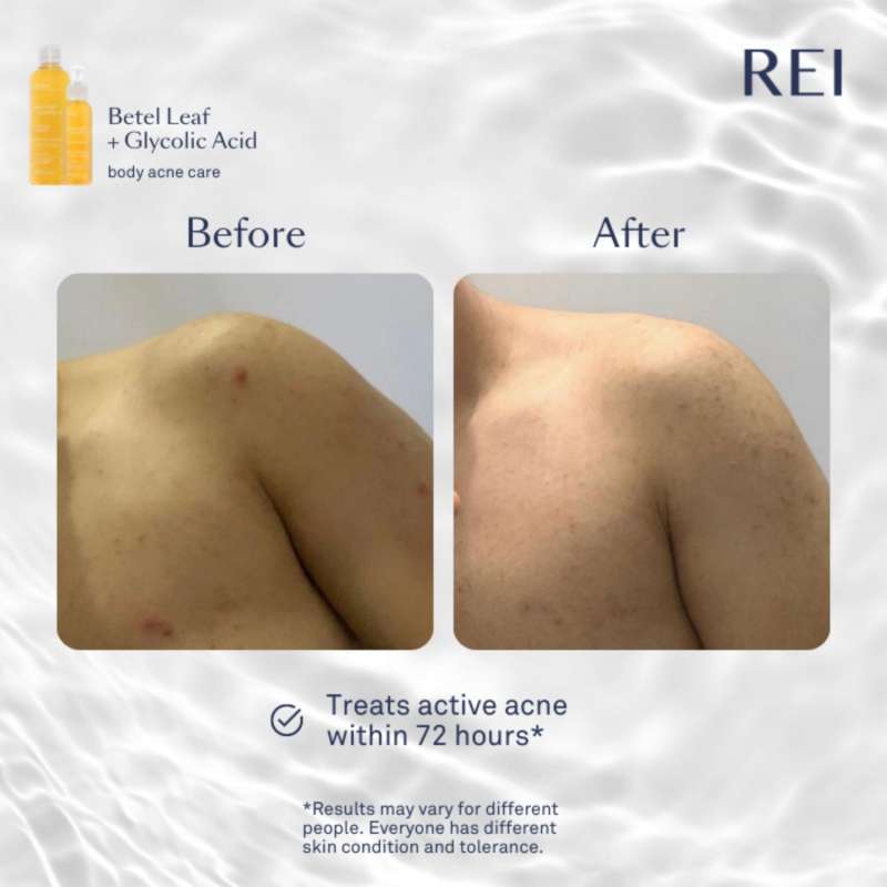 Promo [last Chance] - Rei Skin Betel Leaf + Glycolic Acid Acne Body ...