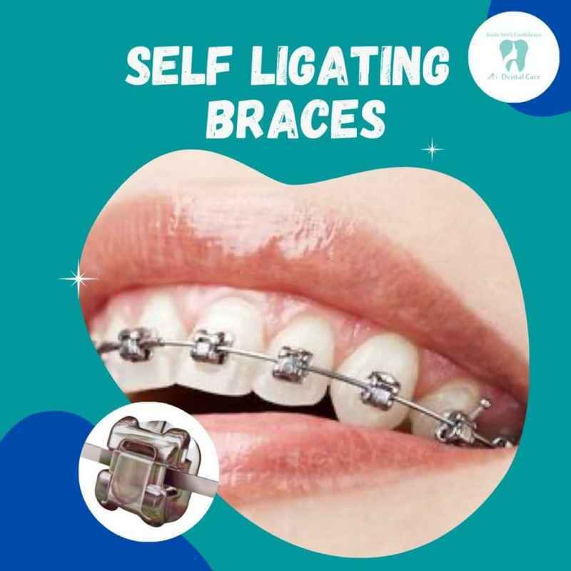 Promo Self Ligating Metal Braces Diskon 50 di Seller A+ Dental Clinic