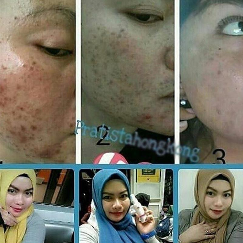 Jual Pratista Krim Penghilang Flek Hitam di Wajah Online