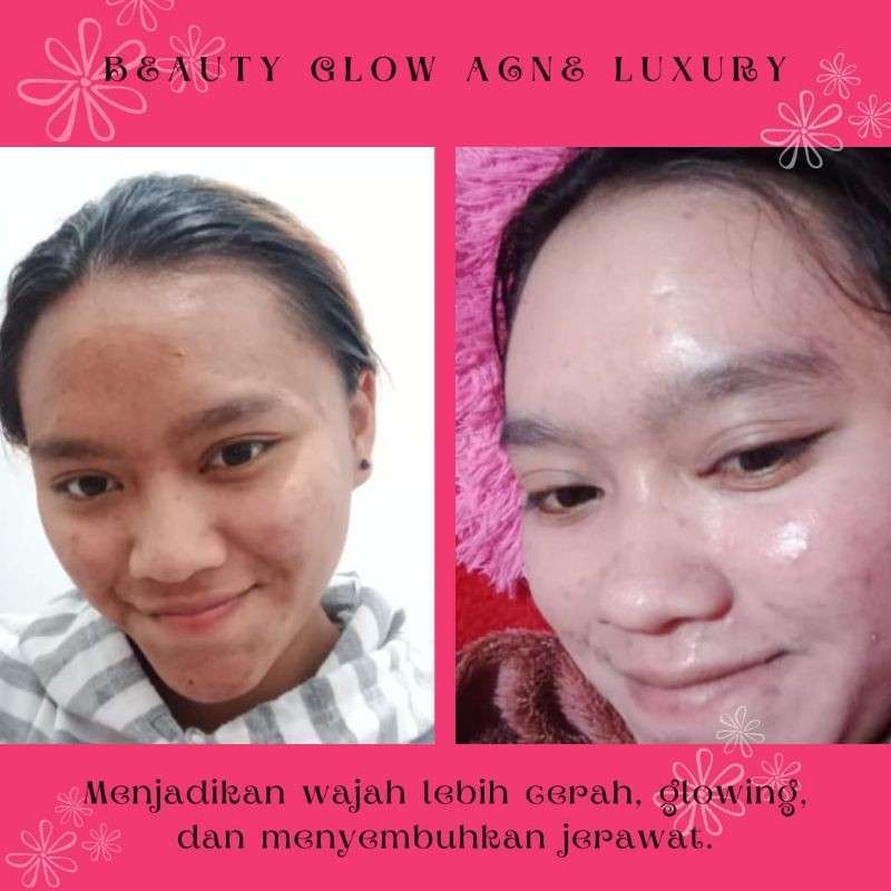 Jual Paket Beauty Glow Acne Luxury bg skin di Seller HB Whitening