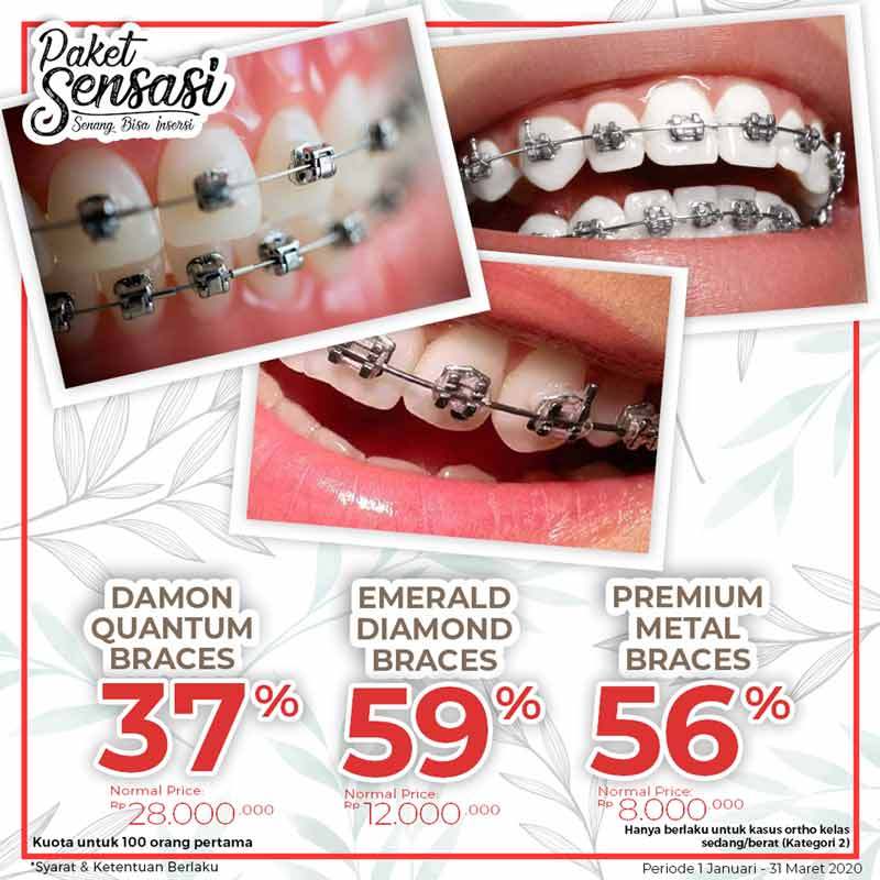 Jual Dental Universe Indonesia Emerald Diamond Braces Tiket di Seller