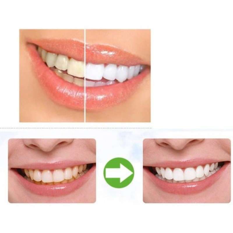 do teeth whitening pens work on veneers Meet A Nice Blogged Image Archive