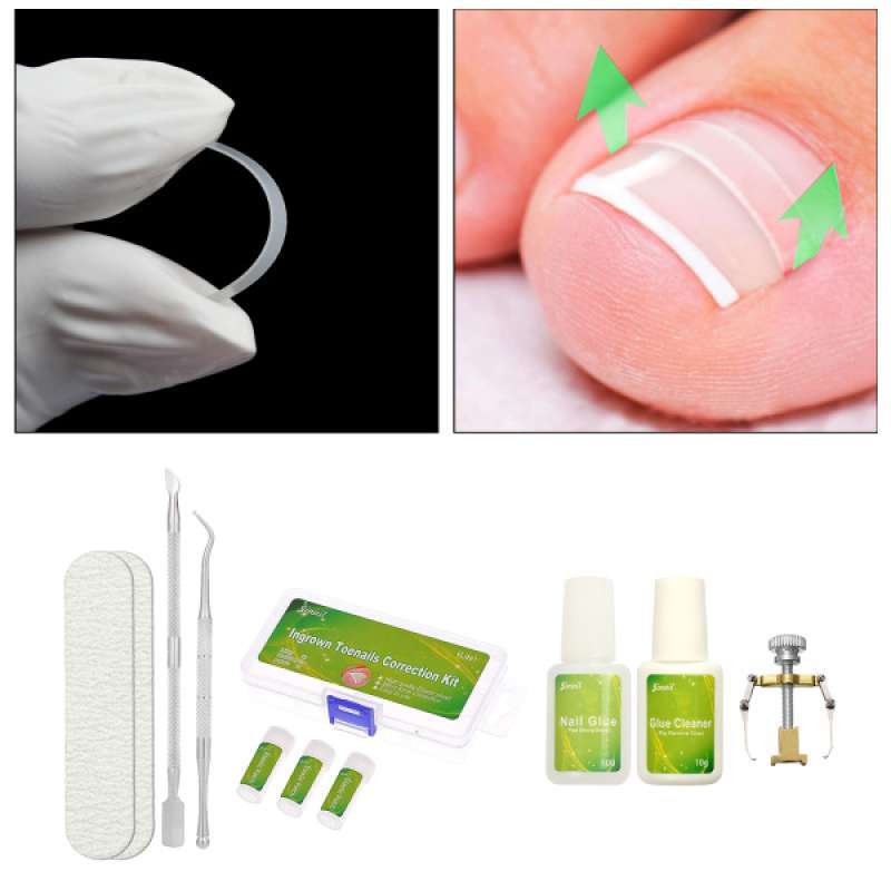 Promo Ingrown Toenail Tools Foot Nail Treatment Correction Clipper Straightening Brace