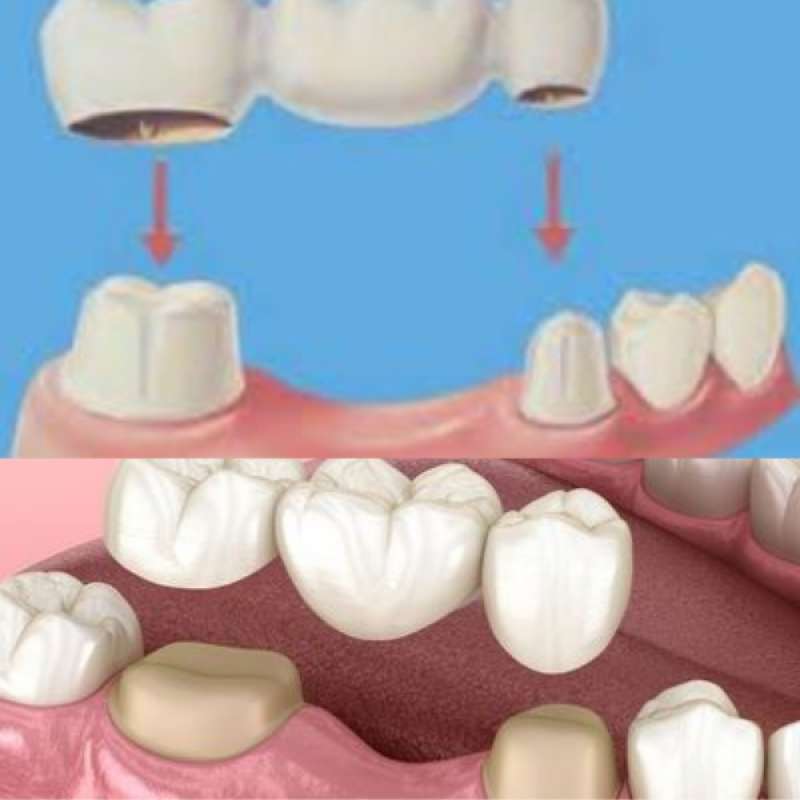 Jual Bridge Gigi Palsu Estetik Zircon di Seller Crown Dental