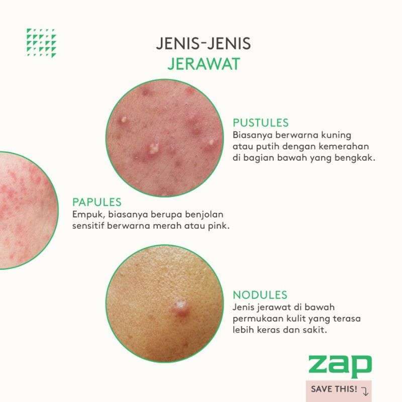 Jual Zap Clinic Active Acne Laser Di Seller Zap Clinic Kalideres
