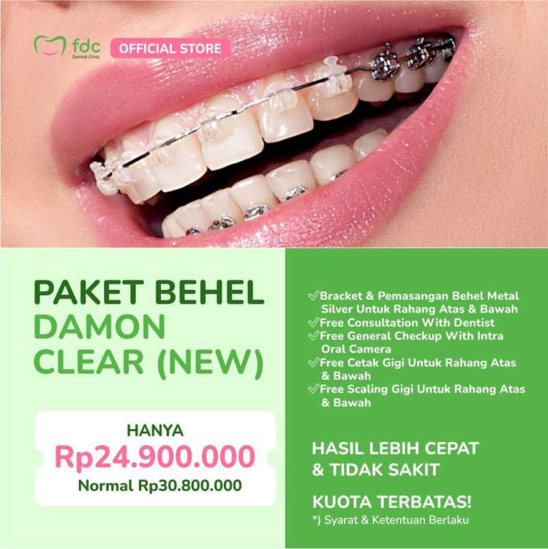 Promo FDC Dental Clinic Bandung Pemasangan Behel Gigi/Ortho/Kawat