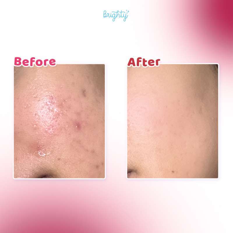 Jual Brighty 20% Aha Bha Pha Lha Peeling Solution X Brighty Glow ...