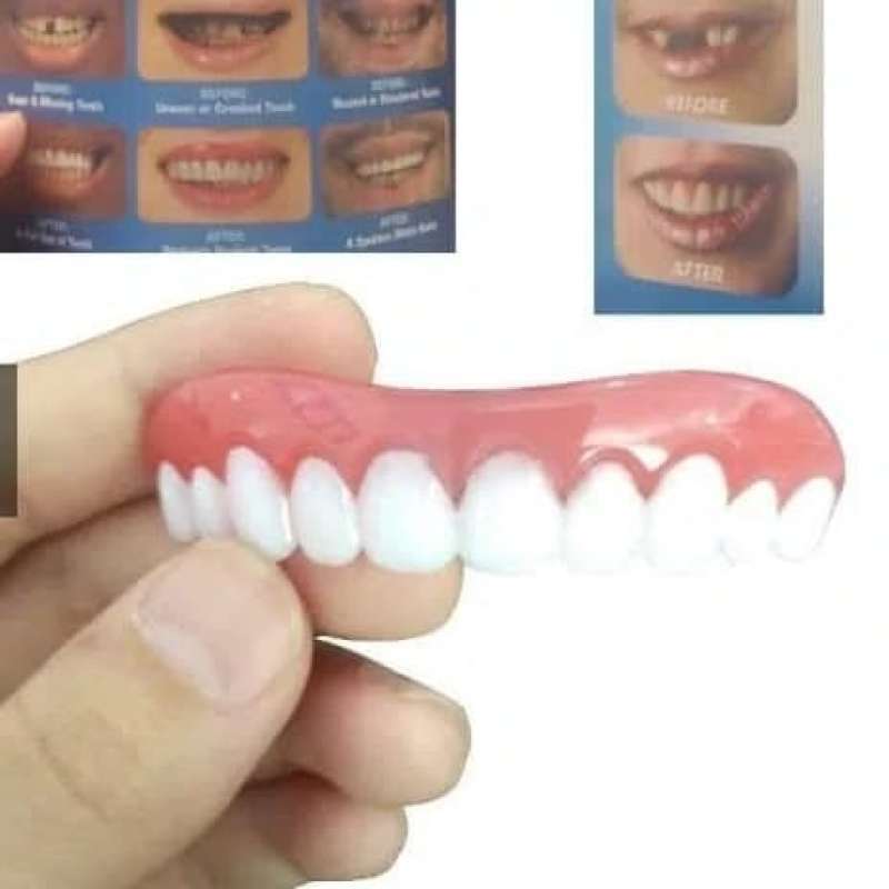 Jual Gigi Veneer Gigi Ompong Tambal Teeth Estetika Kecantikan Mulut Di