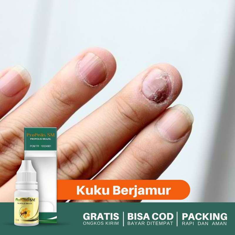 Jual Obat Tetes Kuku Berjamur, Infeksi Kuku Rusak Parah Akibat Jamur