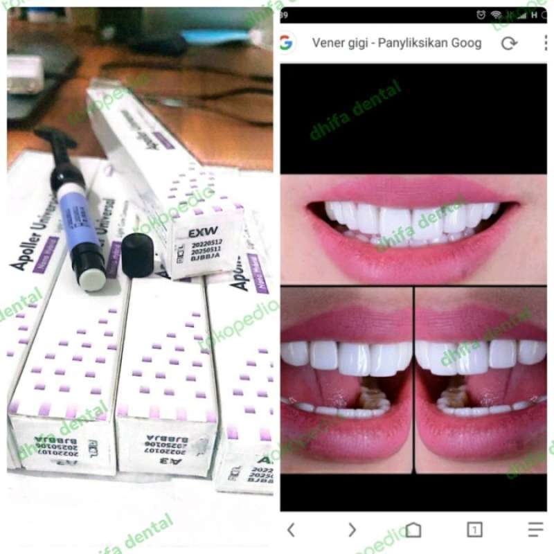 Promo Composite Apoller Universal Veneer XW Nano Hybrid (Xtra White