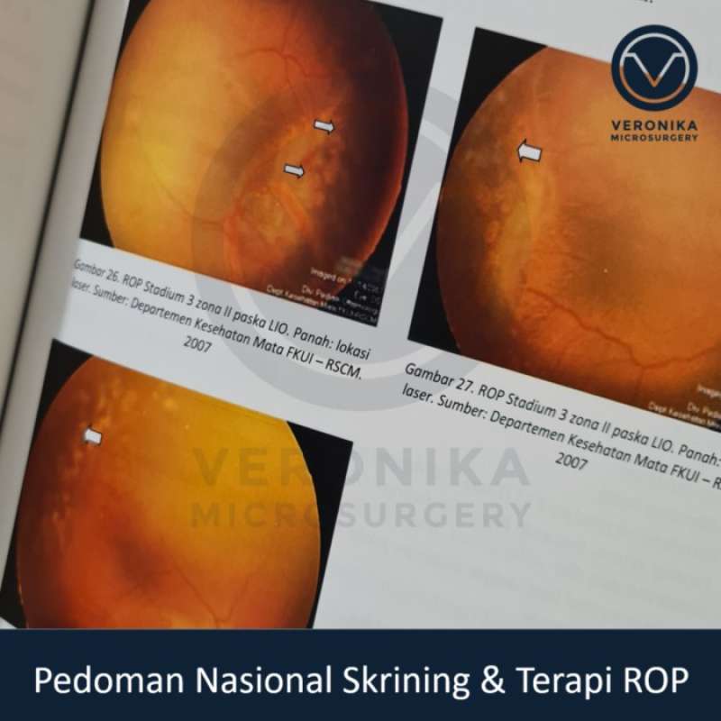 Promo Pedoman Nasional Skrining Dan Terapi Rop Retinopathy Of ...