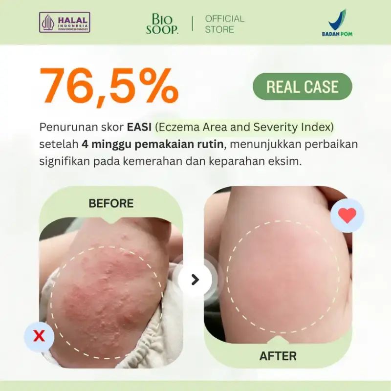 Promo Biosoop Calming Cream B16 40ml | Krim Menenangkan Kulit Bayi Dan ...