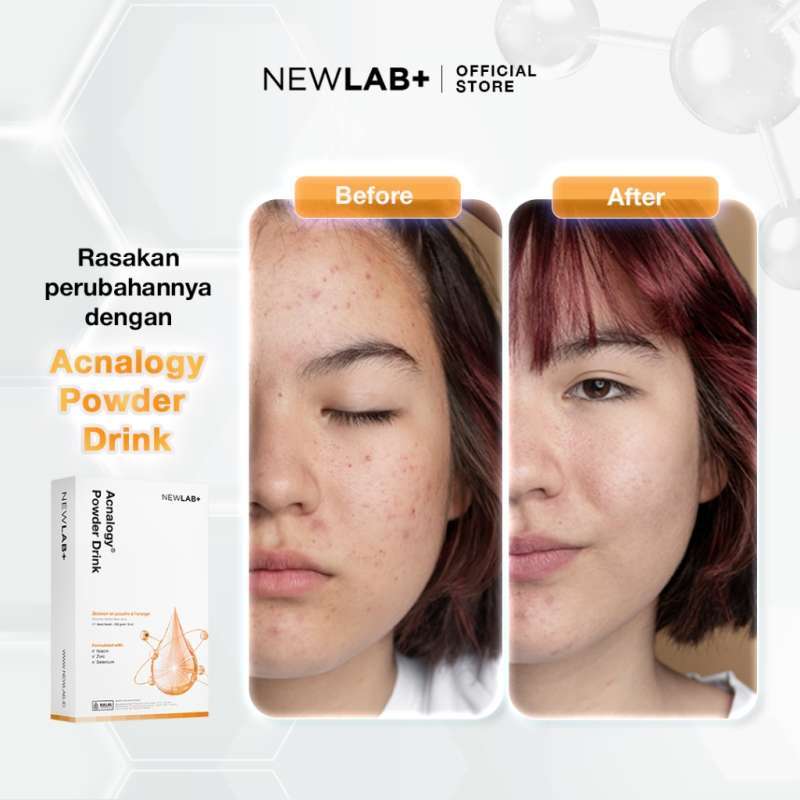 Promo Newlab Acnalogy Powder Drink 250gr - Newlab Obat Minum Jerawat ...