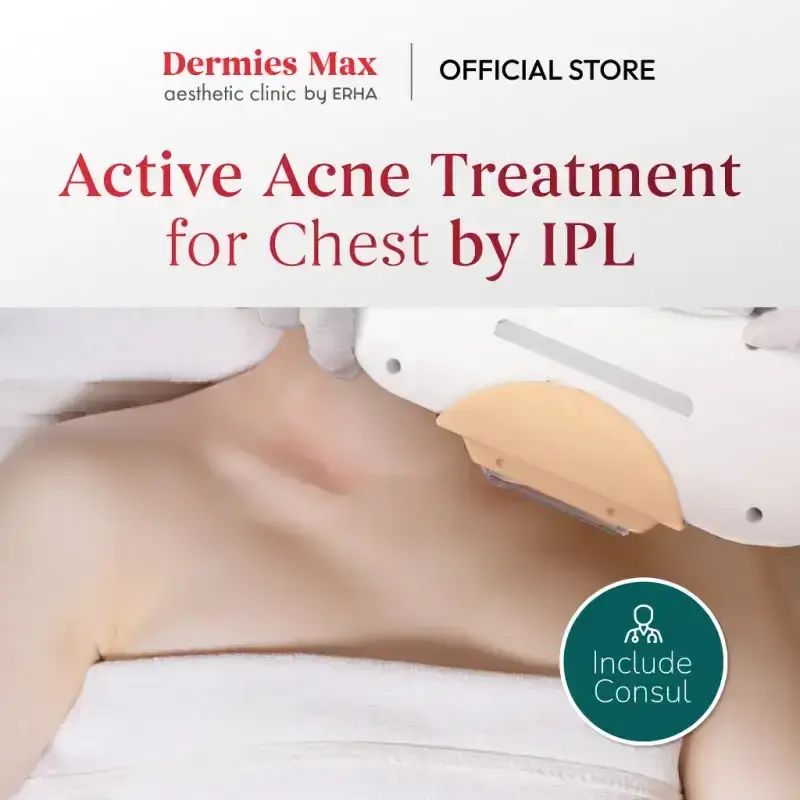 Promo Dermies Max Active Acne Treatment For Chest By Ipl Diskon 5% Di ...