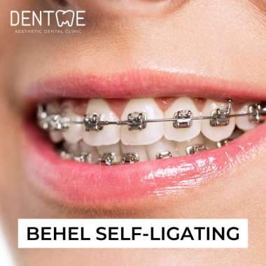 Behel Metal Self-Ligating