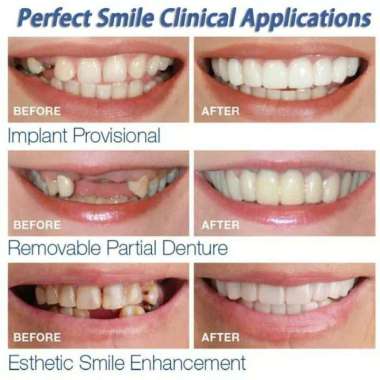 PAKETAN SEPASANG atas bawah SnapOn Smile Authentic Gigi Palsu Snap on Smile 1 Set Veneer Gigi gipal 