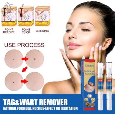 Wart Remover Skin Tag Tag Remover for Men and Women