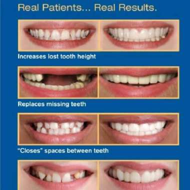 Gigi Palsu Instan Lepas Pasang Orang Dewasa Viral Tiktok Tahan Lama Snap On Smile 100% ORIGINAL Pera