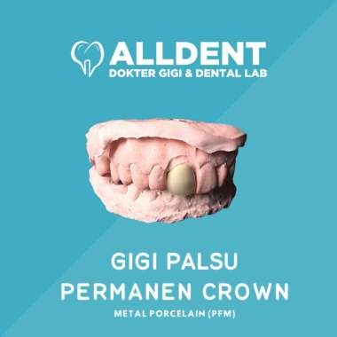 Gigi Palsu Permanen Crown - Metal Porcelain PFM