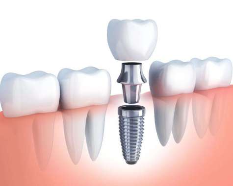 Dental Implant Osstem (Korea)