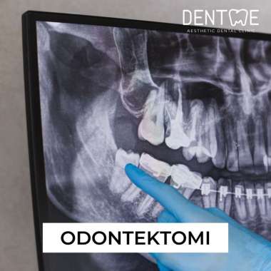 Odontektomi/ Cabut Gigi Bungsu Atas