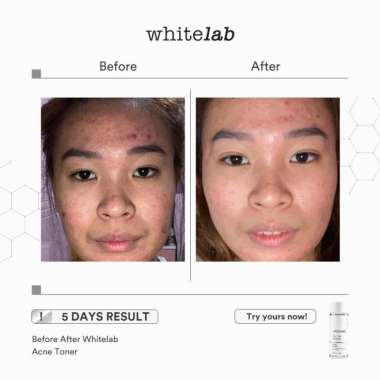 BPOM Whitelab Acne Toner original