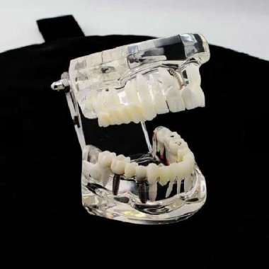 Model Implan Gigi / Manekin Gigi / Peraga gigi dapat dilepas pasang