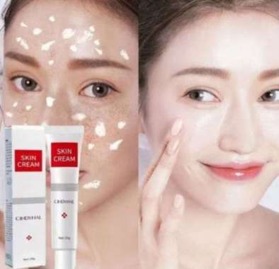 CINDYNAL Skin Cream Freckle Removal/ Krim Pemutih Freckle dan Bintik Whitening Remove Dark Spots Bri