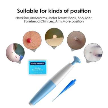 Alat Penghilang Kutil Painless Skin Tag Mole Removal Kit LGV40 - Blue