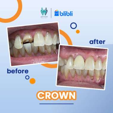 JOYFAM PAKET - CROWN GIGI ZIRCONIA
